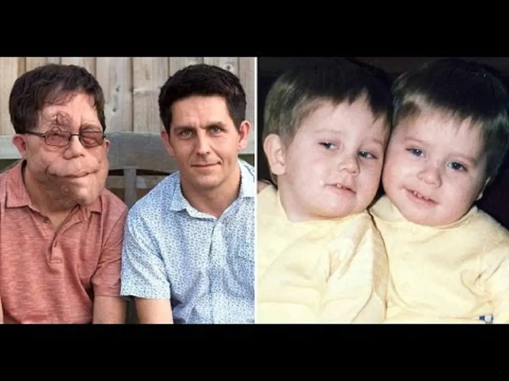Adam Pearson (left) and Neil Pearson (right) both have same genetic disorders but manifests in a different way