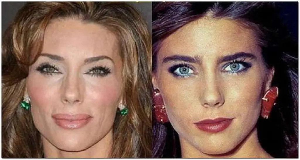 Jennifer Flavin's surgery photos- before (right) and after (left)